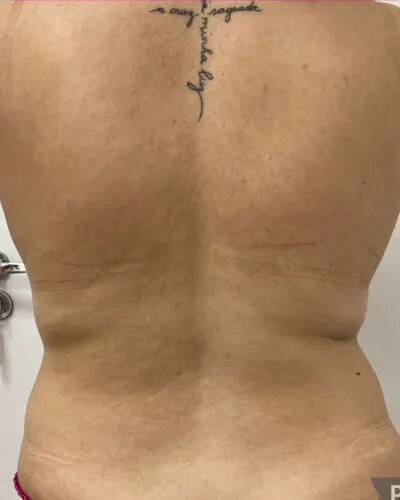 Criolipólise, depois do tratamento