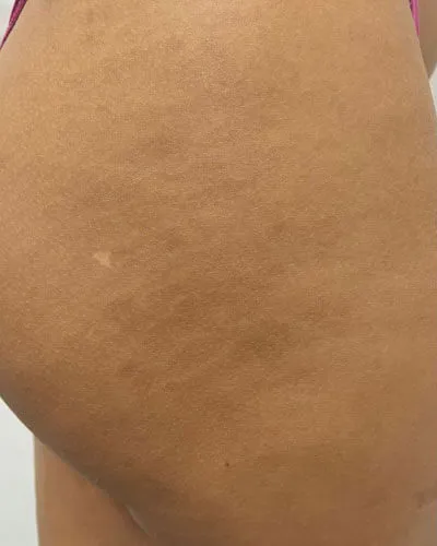 Lavieen Estrias, depois do tratamento