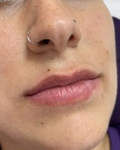Preenchimento Labial, antes do tratamento