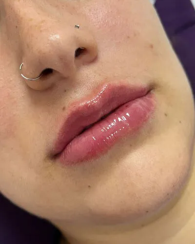 Preenchimento Labial, depois do tratamento