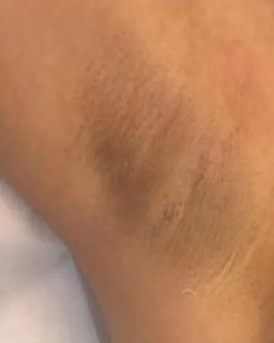Laser Axilas, depois do tratamento