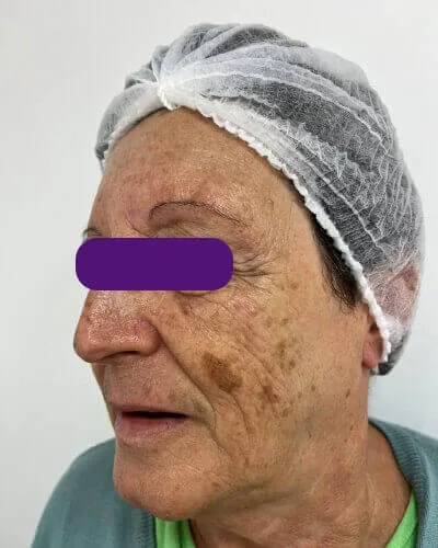 Laser Lavieen, antes do tratamento
