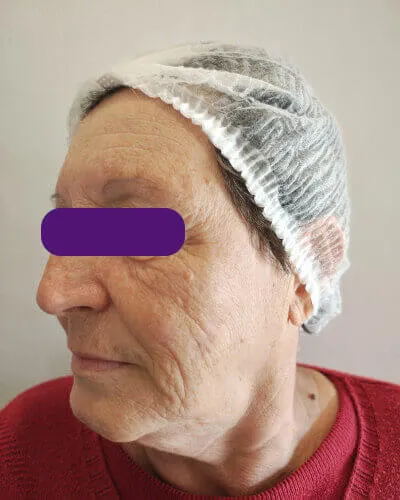 Laser Lavieen, depois do tratamento