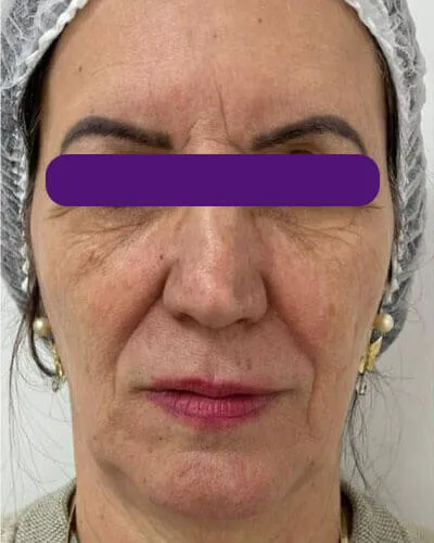 Rejuvenescimento Facial, antes do tratamento