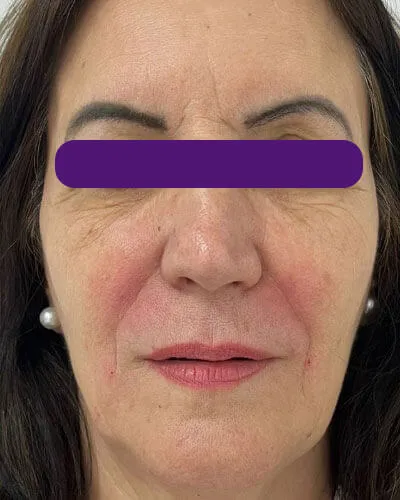 Rejuvenescimento Facial, depois do tratamento