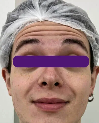 Redução de Rugas, antes do tratamento