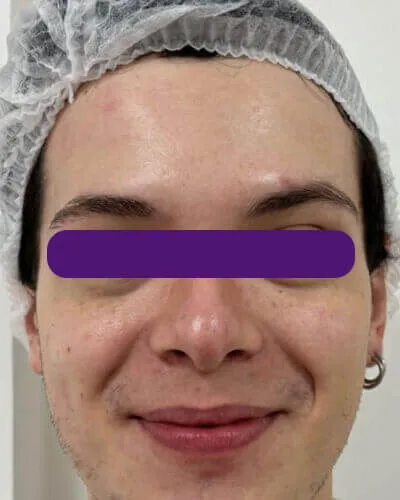 Redução de Rugas, depois do tratamento