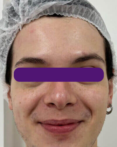 Redução de Rugas